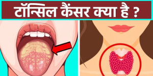 Tonsil Cancer