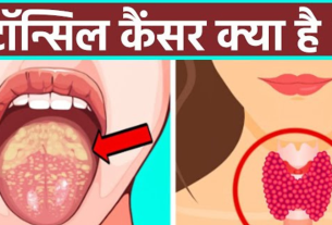 Tonsil Cancer