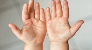 HFMD Infections